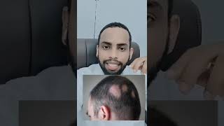 Treatment of Alopecia Areata | daawada bidaarta!