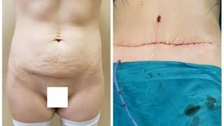 Dr.Bəxtiyar Qəhrəmanovun icra etdiyi abdominoplastika əməliyyatının nəticəsi 070-395-44-55