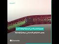 ٤ مراحل تمر بها الكدمة