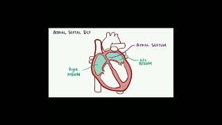 Congenital Heart Disease in children #chd #VSD #ASD