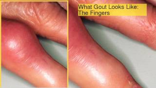 Gout Pictures Causes, Symptoms, and Treatments of Gout