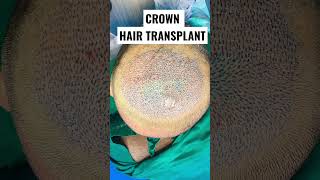 Crown Hair Transplant #ytshorts #shorts #hairloss #drpranilmore #fusionaestheticclinic