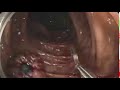 Colonoscopy: Inspection - Dependent - Bleeding 3