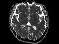 choroid plexus xanthogranuloma