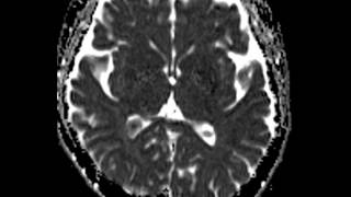 Choroid Plexus Xanthogranuloma