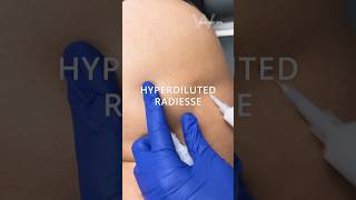 Plump and volumize your buttocks with Hyper Diluted Radiesse at Wise Med Spa in Wayne, NJ!