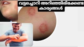 വട്ടച്ചൊറി(Ringworm)എങ്ങനെ വരുന്നു? എന്തൊക്കെ കാര്യങ്ങൾ ശ്രദ്ധിക്കണം?#kerala #ringworm#arogyam