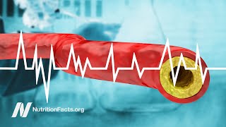 Cholesterol and Heart Disease: Why Has There Been So Much Controversy?