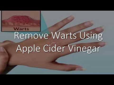 Remove Warts Using Apple Cider Vinegar Remove Warts Using Apple Cider Vinegar