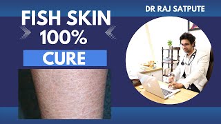 Best Treatment For FISH SKIN | Ichthyosis Vulgaris 100% Cure | FISH SKIN BEST TREATMENT 100% CURE