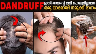 4 SECRET TIPS TO REMOVE DANDRUFF FOREVER || Time For Greatness
