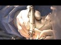 Watch knee replacement using the MAKO Robotic arm