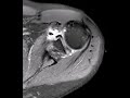 mucoid degeneration of labrum and paralabral cyst