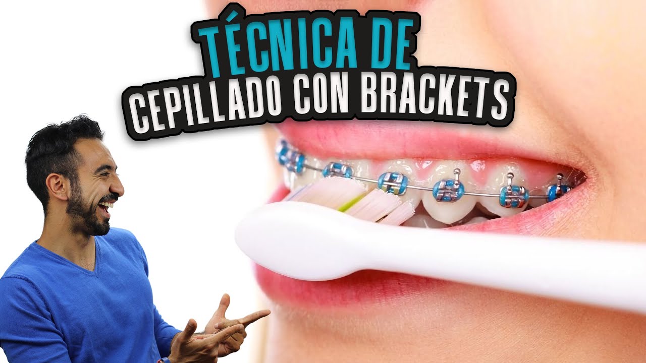 Cómo Cepillarse Los Dientes CON BRACKETS. Técnica De Cepillado Con ...