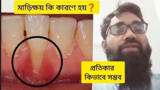 মাড়িক্ষয় কি জন্য হয়ে থাকে এবং এর প্রতিকার কি ভাবে সম্ভব .... Gingival recession cause and treatment