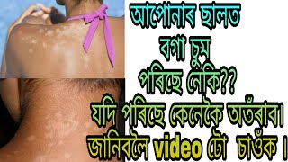 আপোনাৰ ছালত বগা চুম পৰিছে নেকি? যদি পৰিছে কেনেকৈ অতঁৰাব।