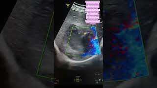 Liver abscess on ultrasound #learningradiology #ultrasonography #learningradiology #diagnosticimagin