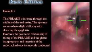 Video Laryngoscope Airway scope(AWS) - Basic edition example7