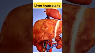 Liver transplant #top #hospital #new #science #shortvideo #dasi #shiv #doctor #liver #basic #reels