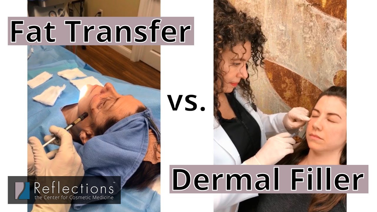 Fat Transfer Vs Filler Which Is Right For You A Plastic Surgeon Who