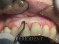 upper anterior teeth root planing