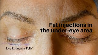 Fat injections in the under-eye area.