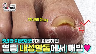 [역대급] 무려 5년간 잘못 자르신 탓에 역대급 긴장하며 관리한 내성발톱! 1~3차 관리 총집합으로 보여드립니다💕 #내성발톱 #레푸스 #현희킴의풋스케치 #ingrowntoenail