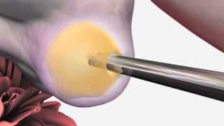 In Vitro Fertilization | Santa Monica Fertility