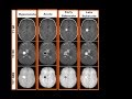 MRI findings of different stages of haemorrhage