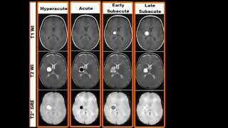 MRI findings of different stages of haemorrhage