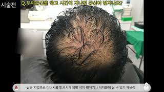 두피문신-Q.두피문신을 하고 시간이 지나면 문신이 번지나요?