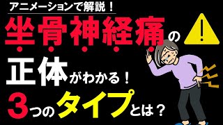 坐骨神経痛の症状と種類について