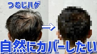 【薄毛】円形脱毛症による頭頂部薄毛がプロのセットで大変身！