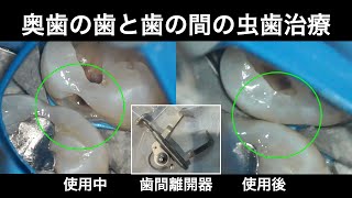 奥歯の歯と歯の間にできた虫歯に対する治療（歯間離開器使用）