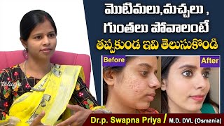 మొటిమల మచ్చలు పోవాలంటే| Tips to Remove Pimple Marks Telugu | Dr Swapna Priya | Health Tips In Telugu