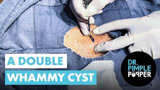 A Double Whammy Cyst