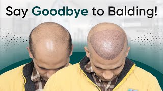 Hair Transplant in Bhopal | Best Results \u0026 Cost of Hair Transplant in Bhopal