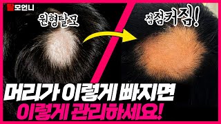 스트레스성 탈모?! 점점 커지고 번지는 이런 탈모는 그냥 두면 큰일난다?(*Eng)