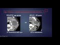 Pediatric Neck Masses -- Srikala Narayanan -- 2.9.2023