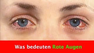 Was bedeuten Rote Augen und warum können sie entstehen?