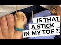 HOW TO END Ingrown Toenails FOREVER!