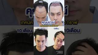 ปลูกผมลดอายุ‼️คุณบราวน์ปลูกผมครบ 10 เดือน#ปลูกผม #ปลูกผมถาวร #hairtransplant #หัวล้าน #รีวิวปลูกผม