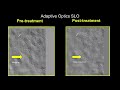 quantification and dynamic characterization of intermittent retinal capillary perfusion in