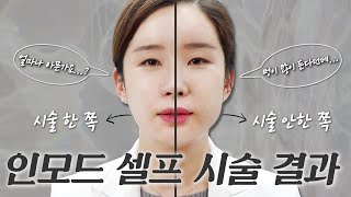 🔥인모드 셀프 시술🔥 인모드 멍, 통증, 부작용, 시술 방식, 시술 시간, 주의사항 등 인모드의 모든 것을 알려드립니다!