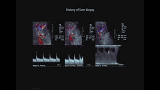 Pitfalls and Challenges in Doppler Ultrasound