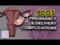 PCOS Pregnancy complications | High risk | Birth Defects?