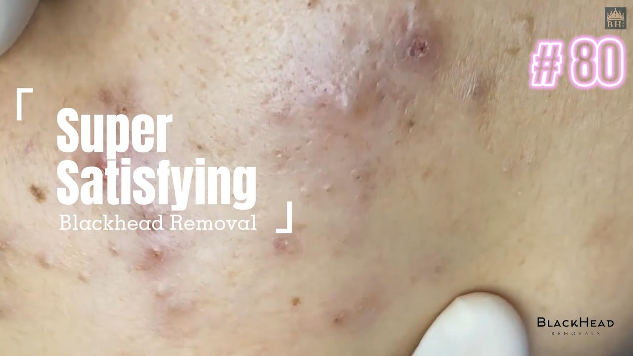 Super Satisfying BLACKHEAD REMOVAL - YouTube