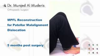 MPFL Reconstruction for Patellar Malalignment Dislocation - 5 months post surgery