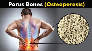 What happens in Osteoporosis | animation |