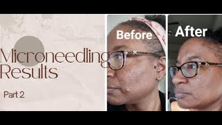 Microneedling on Dark Skin (2nd treatment) Results